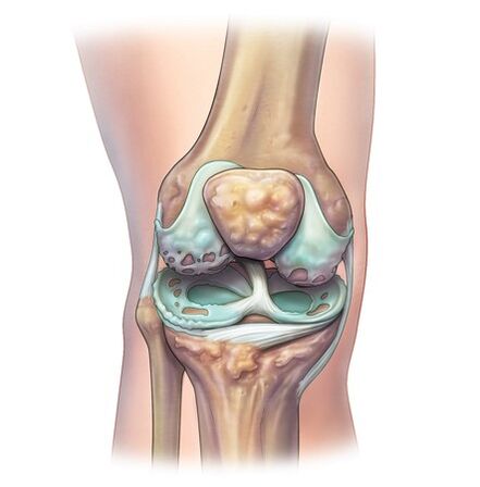 Destrucción de las articulaciones con el desarrollo de la osteocondrosis