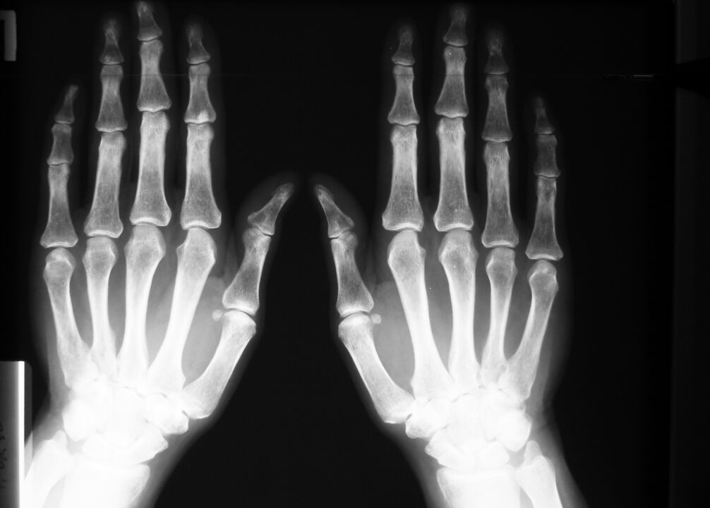 Radiografía para diagnosticar dolor en las articulaciones de los dedos.