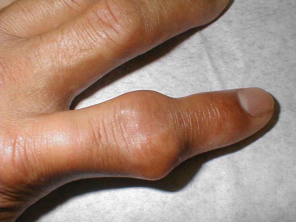 Topos en la articulación del dedo como causa de dolor.